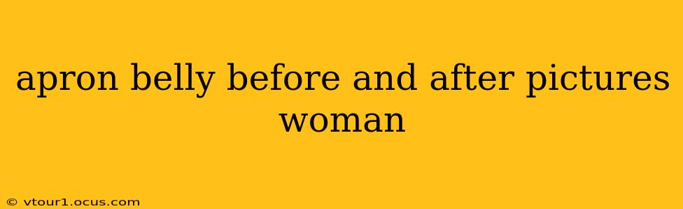 apron belly before and after pictures woman