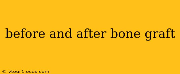 before and after bone graft