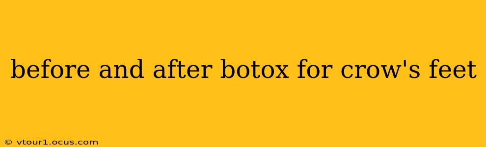 before and after botox for crow's feet