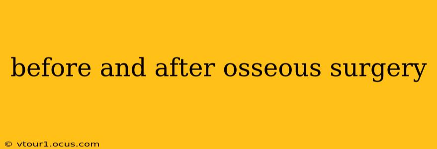 before and after osseous surgery