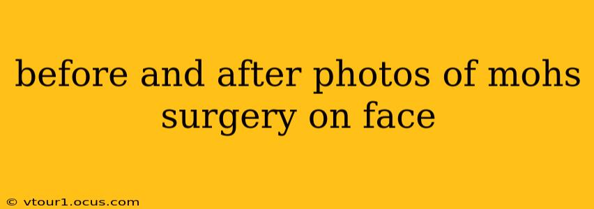 before and after photos of mohs surgery on face
