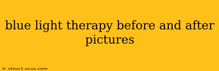 blue light therapy before and after pictures