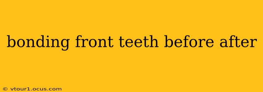 bonding front teeth before after