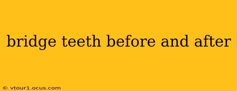 bridge teeth before and after