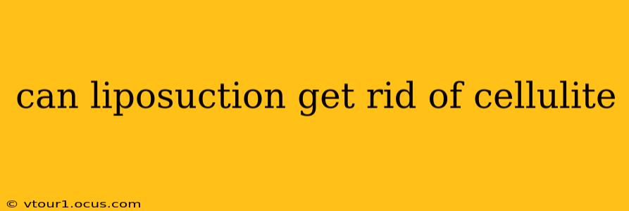 can liposuction get rid of cellulite