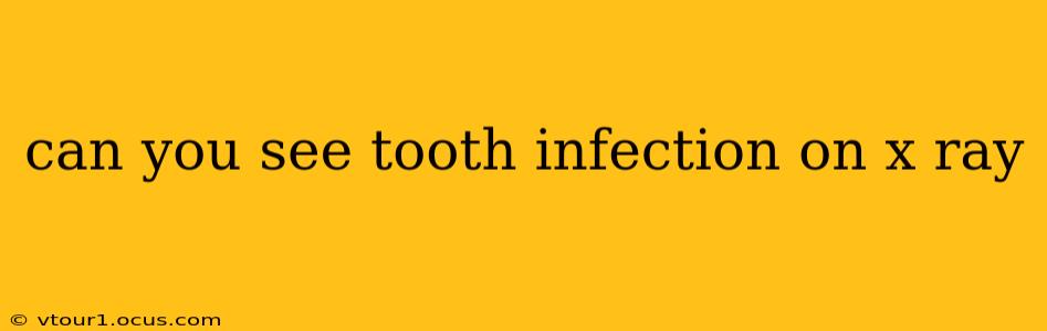 can you see tooth infection on x ray