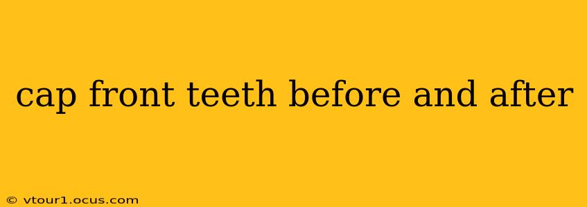 cap front teeth before and after