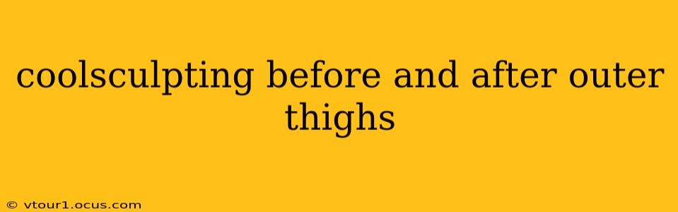 coolsculpting before and after outer thighs