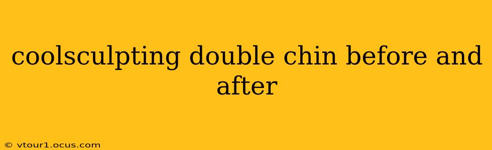 coolsculpting double chin before and after