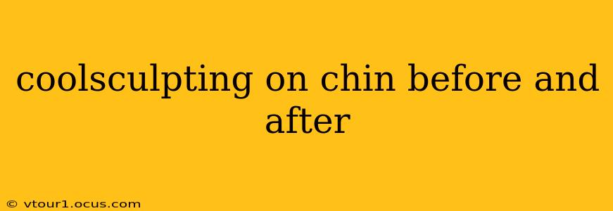 coolsculpting on chin before and after