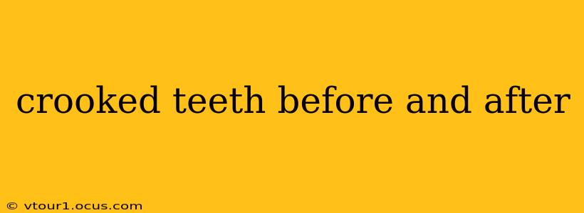 crooked teeth before and after