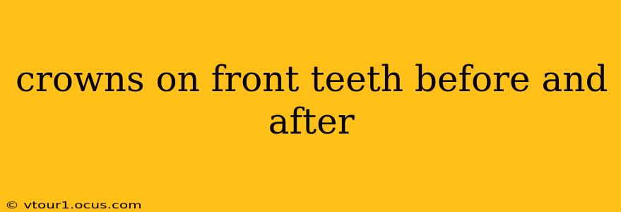 crowns on front teeth before and after