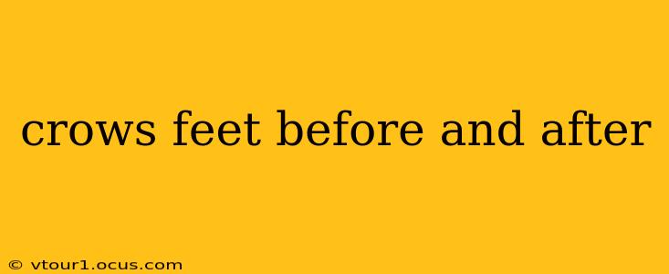 crows feet before and after