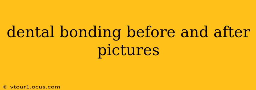 dental bonding before and after pictures