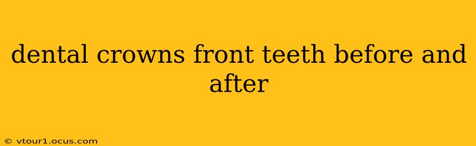 dental crowns front teeth before and after