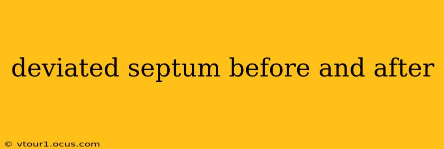 deviated septum before and after