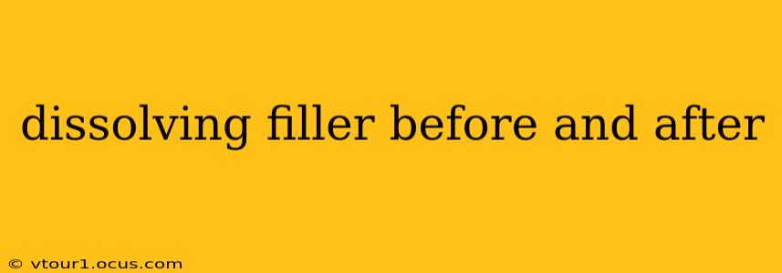 dissolving filler before and after