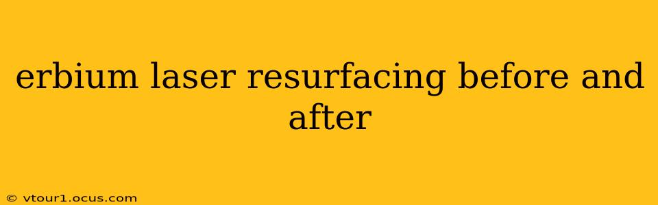 erbium laser resurfacing before and after