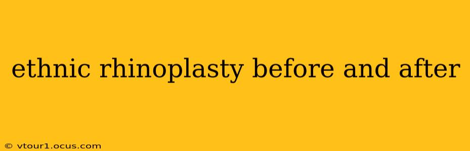 ethnic rhinoplasty before and after