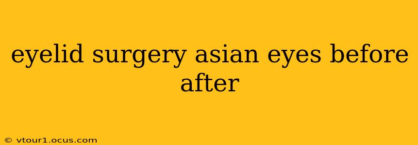 eyelid surgery asian eyes before after
