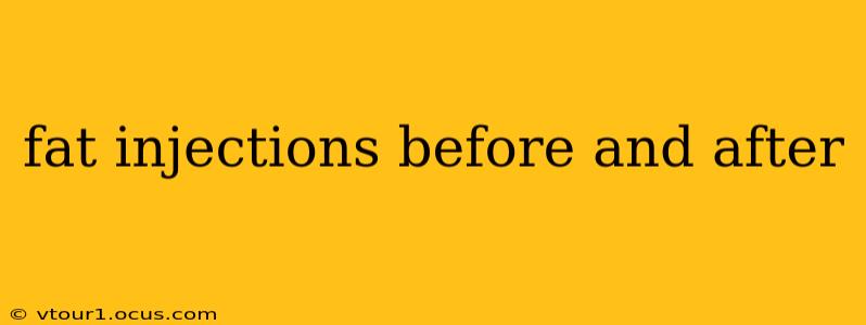 fat injections before and after