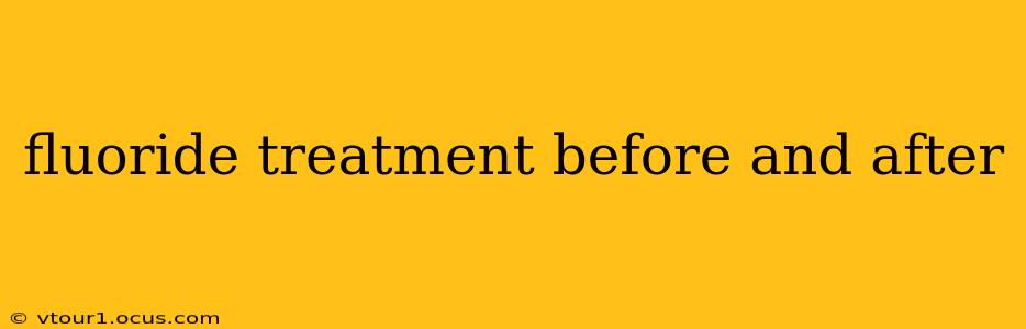 fluoride treatment before and after