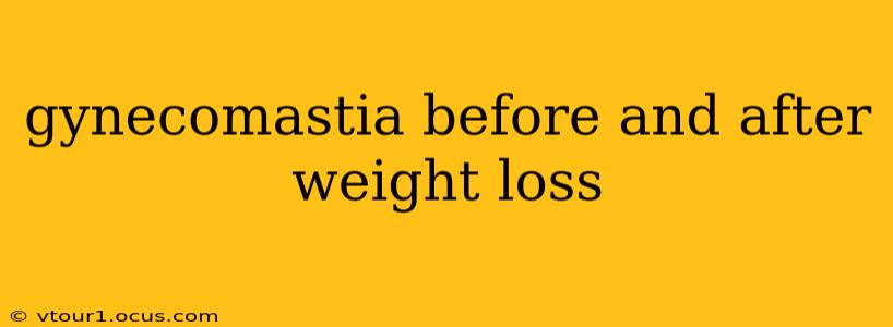 gynecomastia before and after weight loss