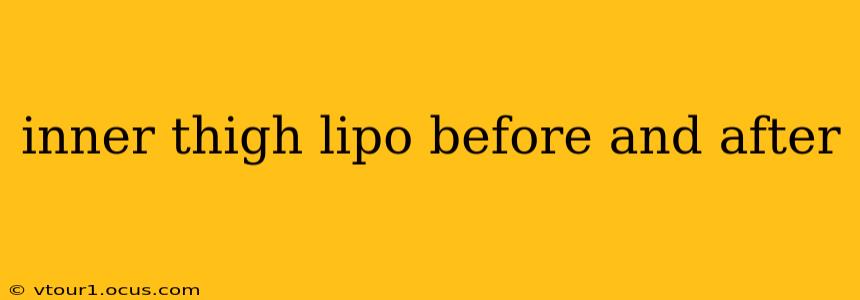 inner thigh lipo before and after