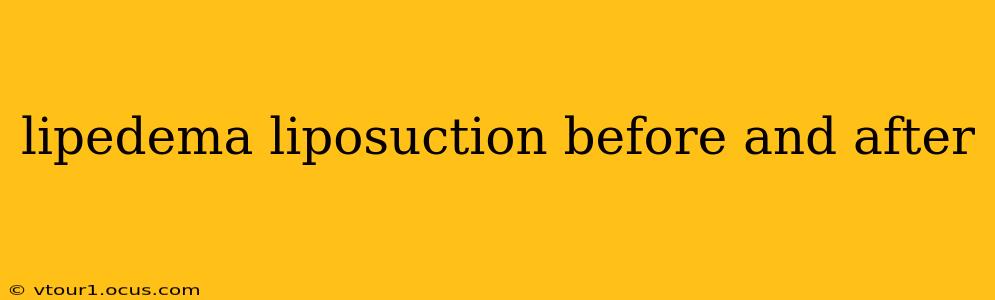 lipedema liposuction before and after