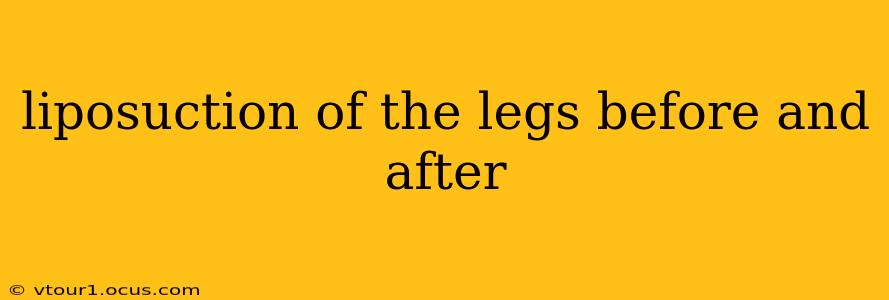 liposuction of the legs before and after