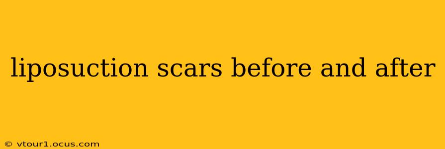liposuction scars before and after