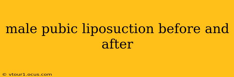 male pubic liposuction before and after