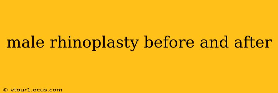 male rhinoplasty before and after