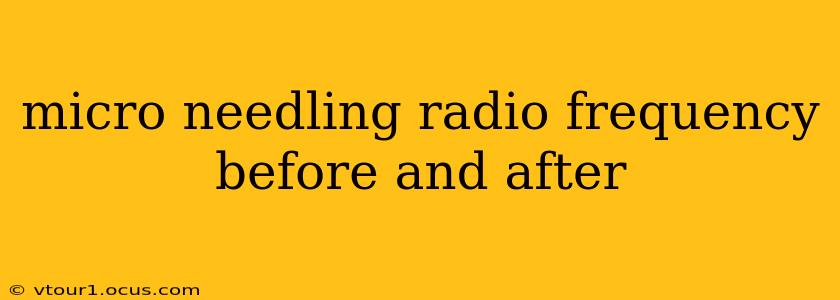 micro needling radio frequency before and after