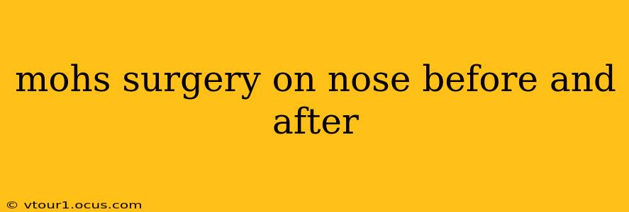 mohs surgery on nose before and after