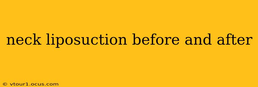 neck liposuction before and after