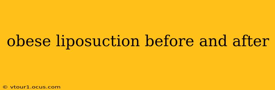 obese liposuction before and after