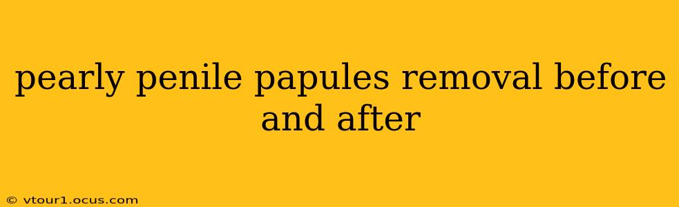pearly penile papules removal before and after