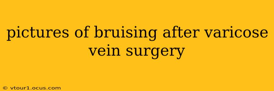 pictures of bruising after varicose vein surgery
