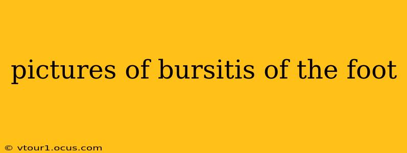 pictures of bursitis of the foot