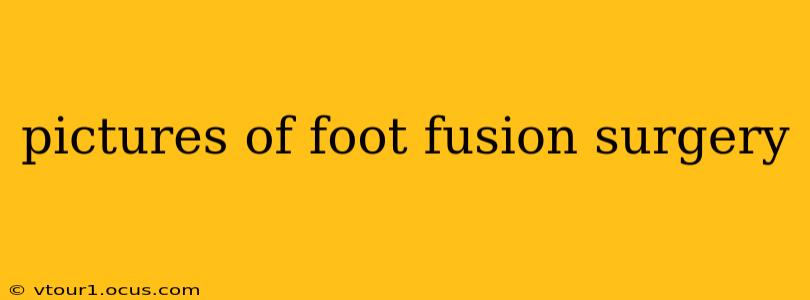 pictures of foot fusion surgery