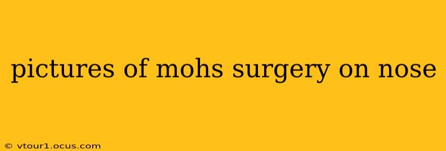 pictures of mohs surgery on nose