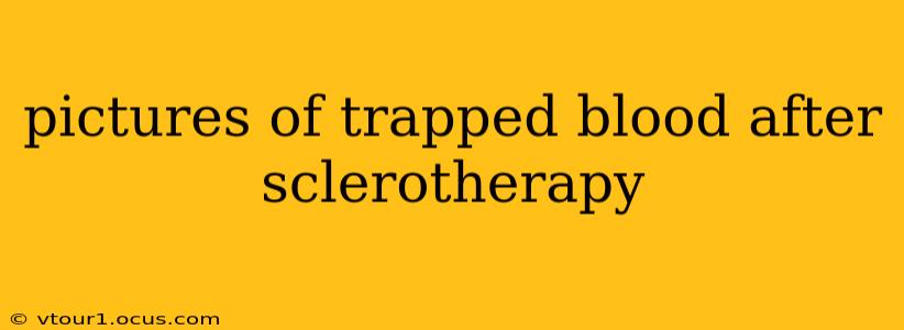pictures of trapped blood after sclerotherapy