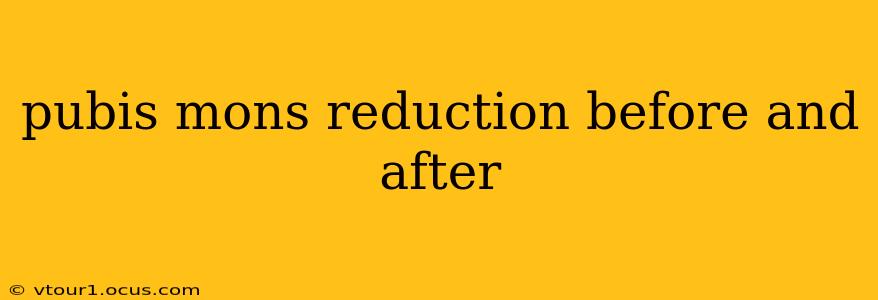 pubis mons reduction before and after