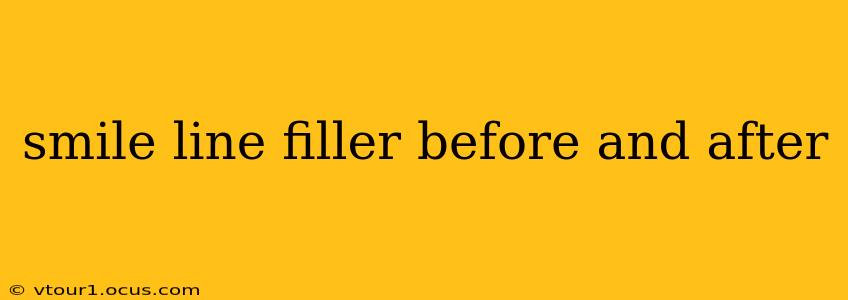 smile line filler before and after