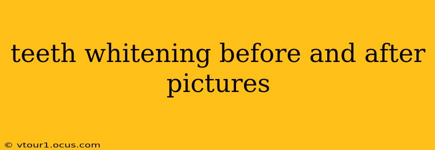 teeth whitening before and after pictures