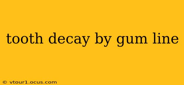tooth decay by gum line