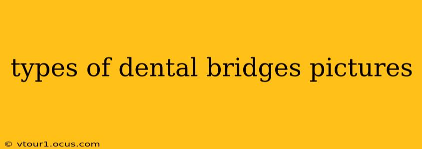 types of dental bridges pictures