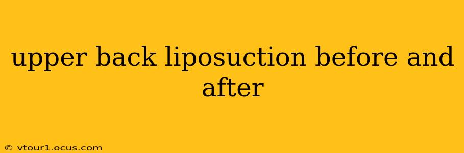 upper back liposuction before and after