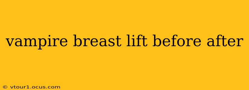 vampire breast lift before after